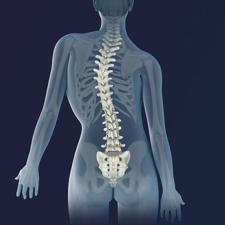 Scoliosis